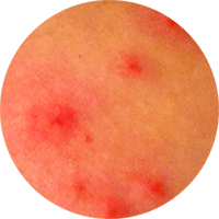 punture da acaro del tarlo sull'uomo